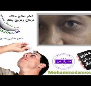 Embedded thumbnail for  علاج انسداد القناة الدمعية